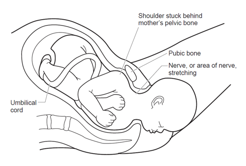 Shoulder dystocia