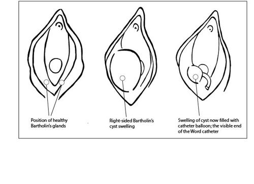 Diagram showing the position of healthy Bartholin's glands, right-sided Bartholin's cyst swelling, and swelling of a cyst filled with a Word catheter balloon