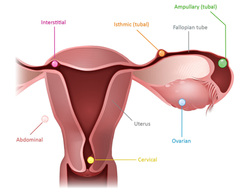 Ectopic 4