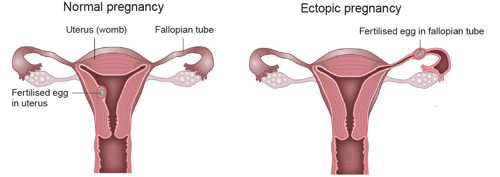 Ectopic image 3