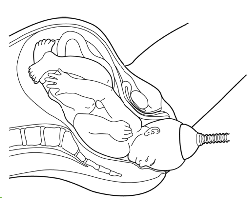Ventouse birth